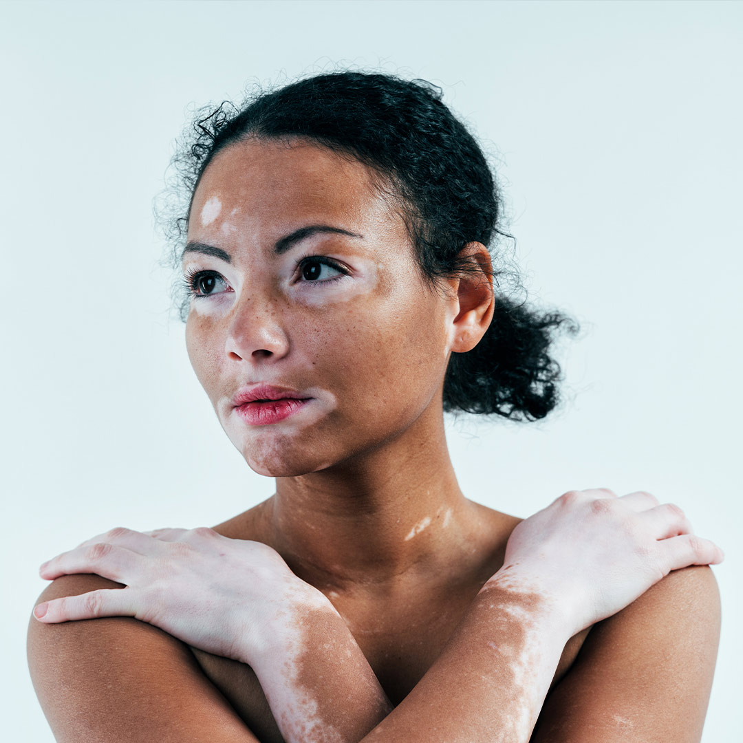 beautiful woman with vitiligo
